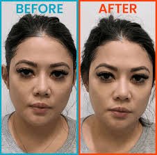HIFU Face Lift Results